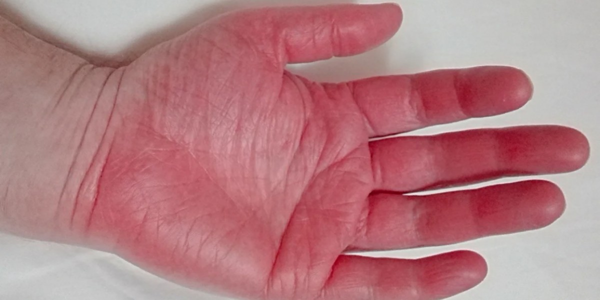 Understanding Erythromelalgia Pain: Causes, Symptoms, and Treatment Options