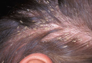 Best Homeopathic Doctor & Treatment of Dandruff in India