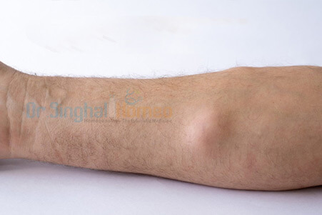 Lipoma Treatment in Homeopathic Medicine at Dr. Singhal Homeo